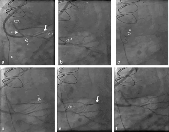 Highly symptomatic patient with three stenoses beyond a previous vein graft