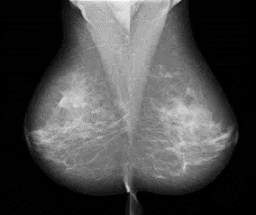 Image examples of lateral mammograms acquired with MMD1012 (e-Join)