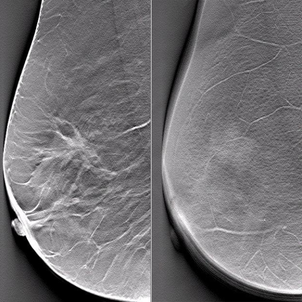 Reconstructed slices of a patient data set in MLO projections, (left) slice at z = 21 mm above patient table, (right) slice close to the surface of the breast (e-Join)