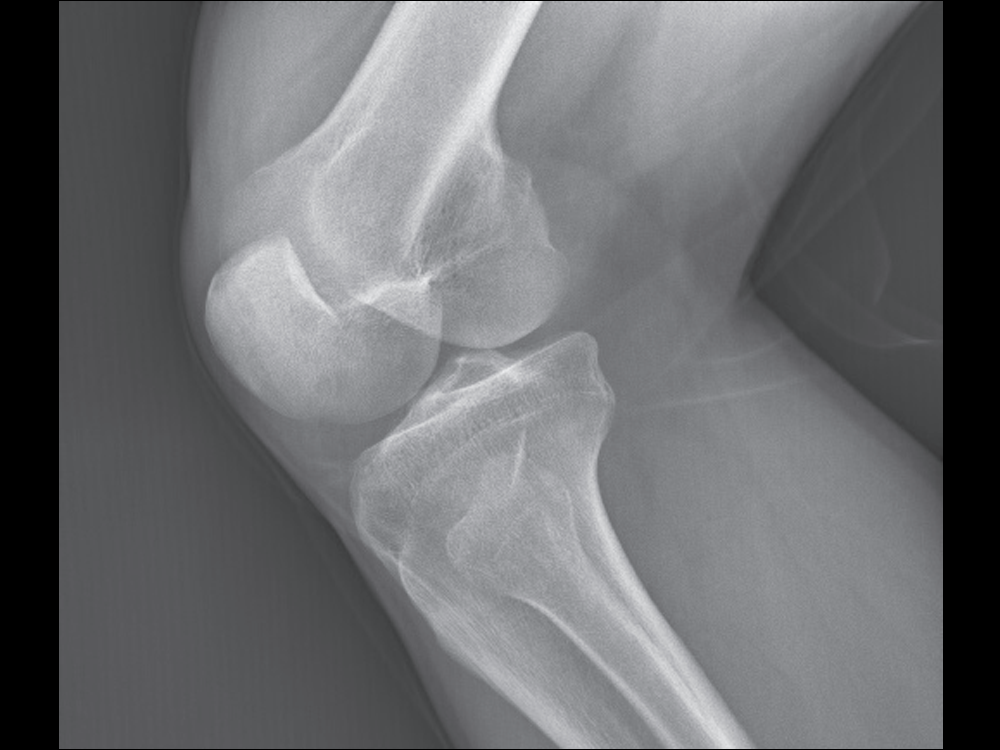 X-ray Kneecap Image of Medical Digital Radiography X-ray Fluoroscopy C-arm Machine DC8600