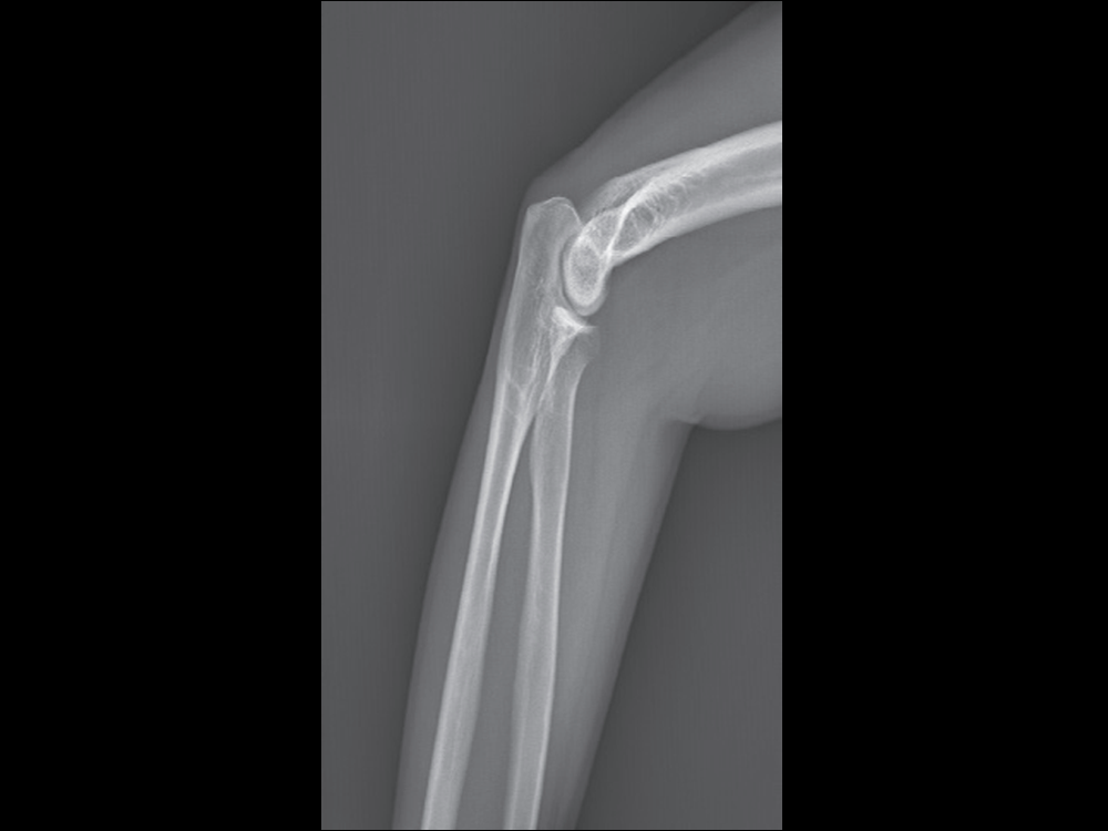 X-ray Elbow Image of Medical Digital Radiography X-ray Fluoroscopy C-arm Machine DC8600