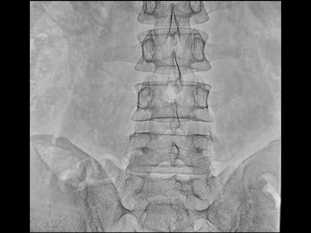 Frontal Position of Lumbar Vertebra for Medical Digital Radiography X-ray Fluoroscopy C-arm Machine DC8600