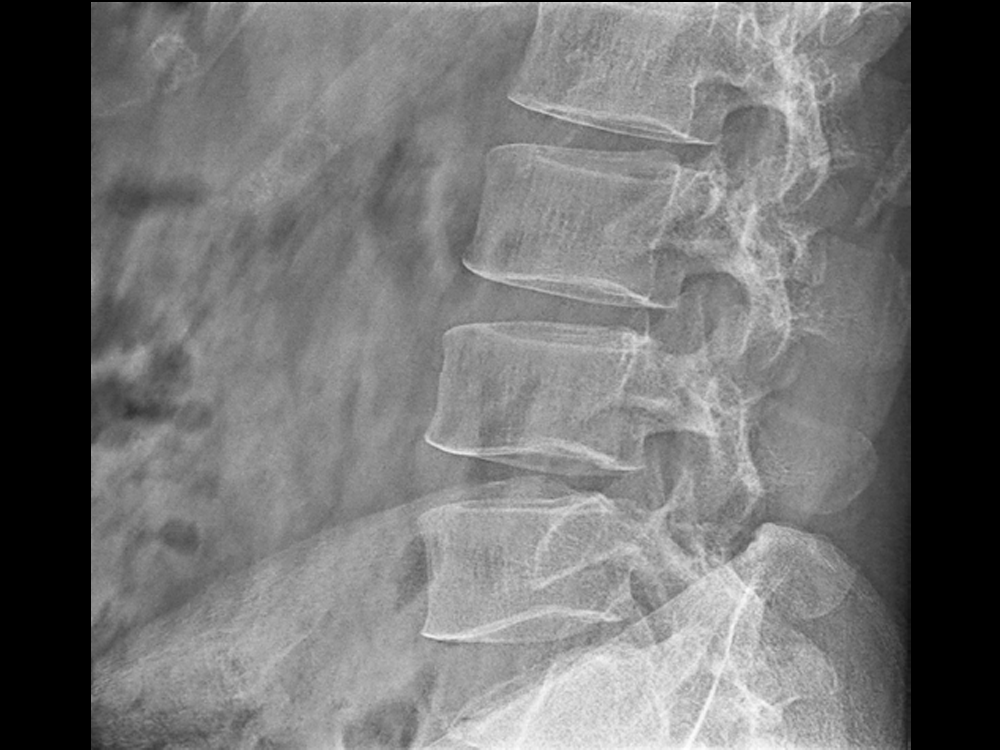 Lateral Position of Lumbar Vertebra for Medical Digital Radiography X-ray Fluoroscopy C-arm Machine DC8600