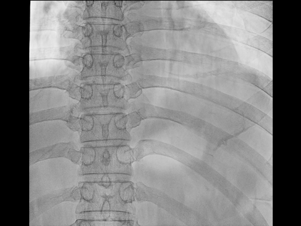Frontal Position of Thoracic Vertebra for Medical Digital Radiography X-ray Fluoroscopy C-arm Machine DC8600
