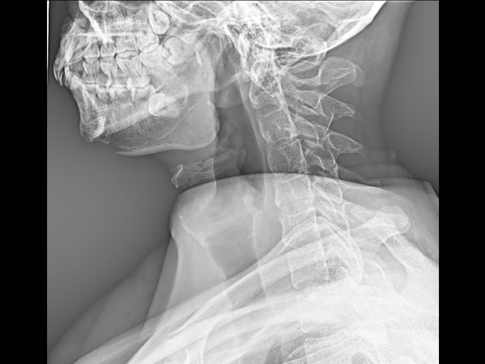 Lateral Position of Cervical Vertebra for Medical Digital Radiography X-ray Fluoroscopy C-arm Machine DC8600