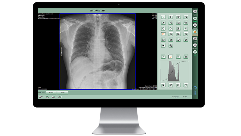 Workstation Processing Function of Fixed Floor-mounted Medical Digital Radiography X-ray Machine DF6500