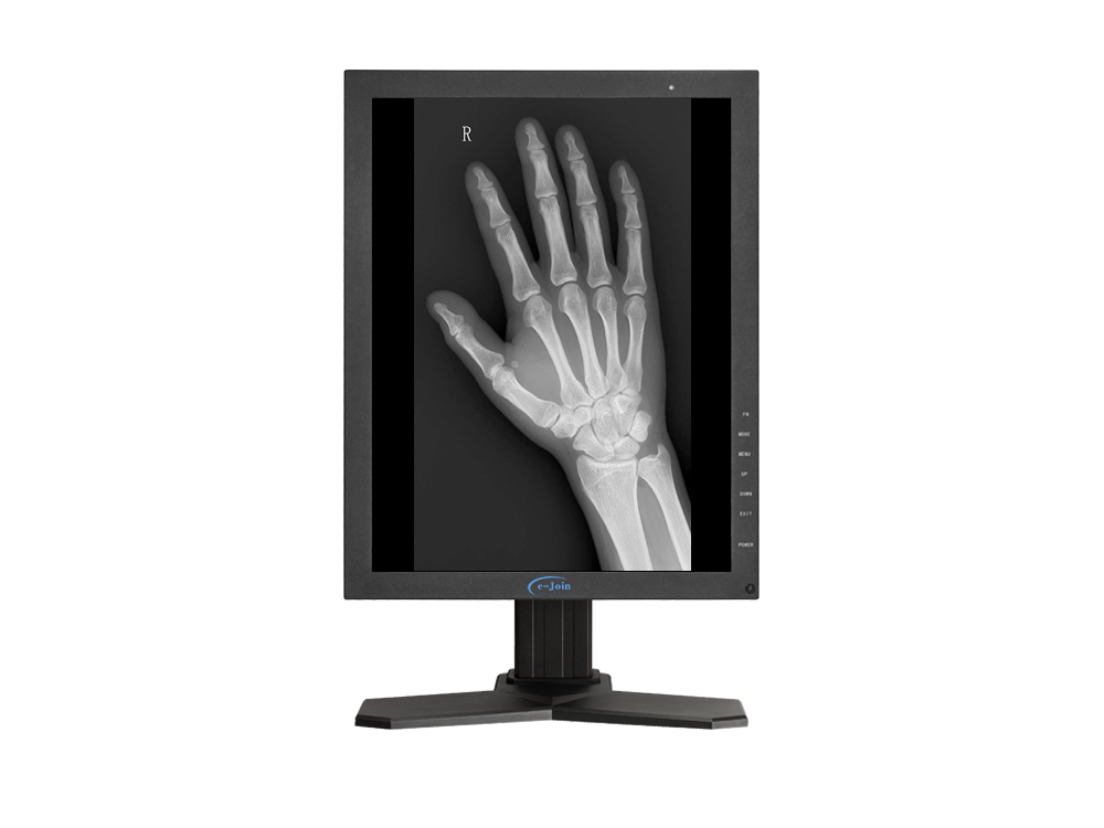 X-ray Hand Image of Fixed Floor-mounted Medical Digital Radiography X-ray Machine DF6500