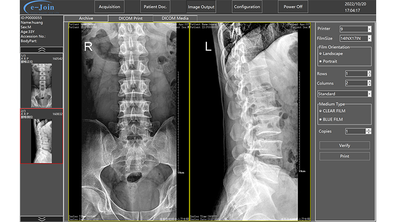 Workstation Printing Function of Medical Digital Radiography Portable X-ray Machine DP5600