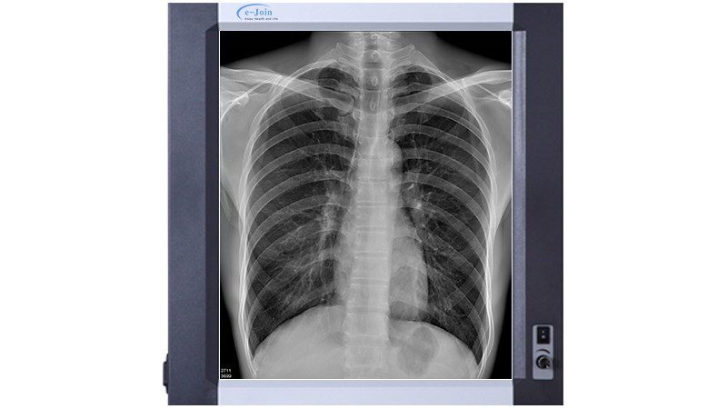 X-ray Chest Image of 320 dpi High Quality Tabletop Digital Thermal DICOM Imaging Film Printer DT300