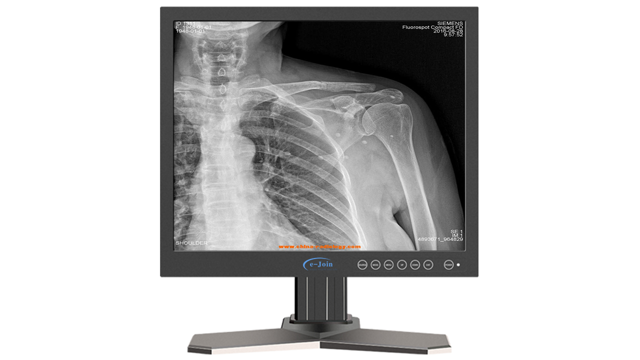 HDMI LED Medical Radiology X-ray Grayscale Display Screen Monitor RG17 for Chest X-ray Image