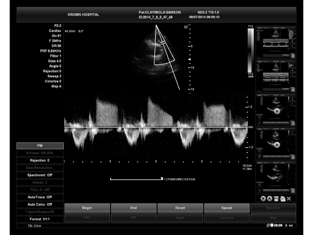 Ultrasound Image of Medical Thermal Diagnostic Imaging Dry Clear Ultrasound Paper UTP110